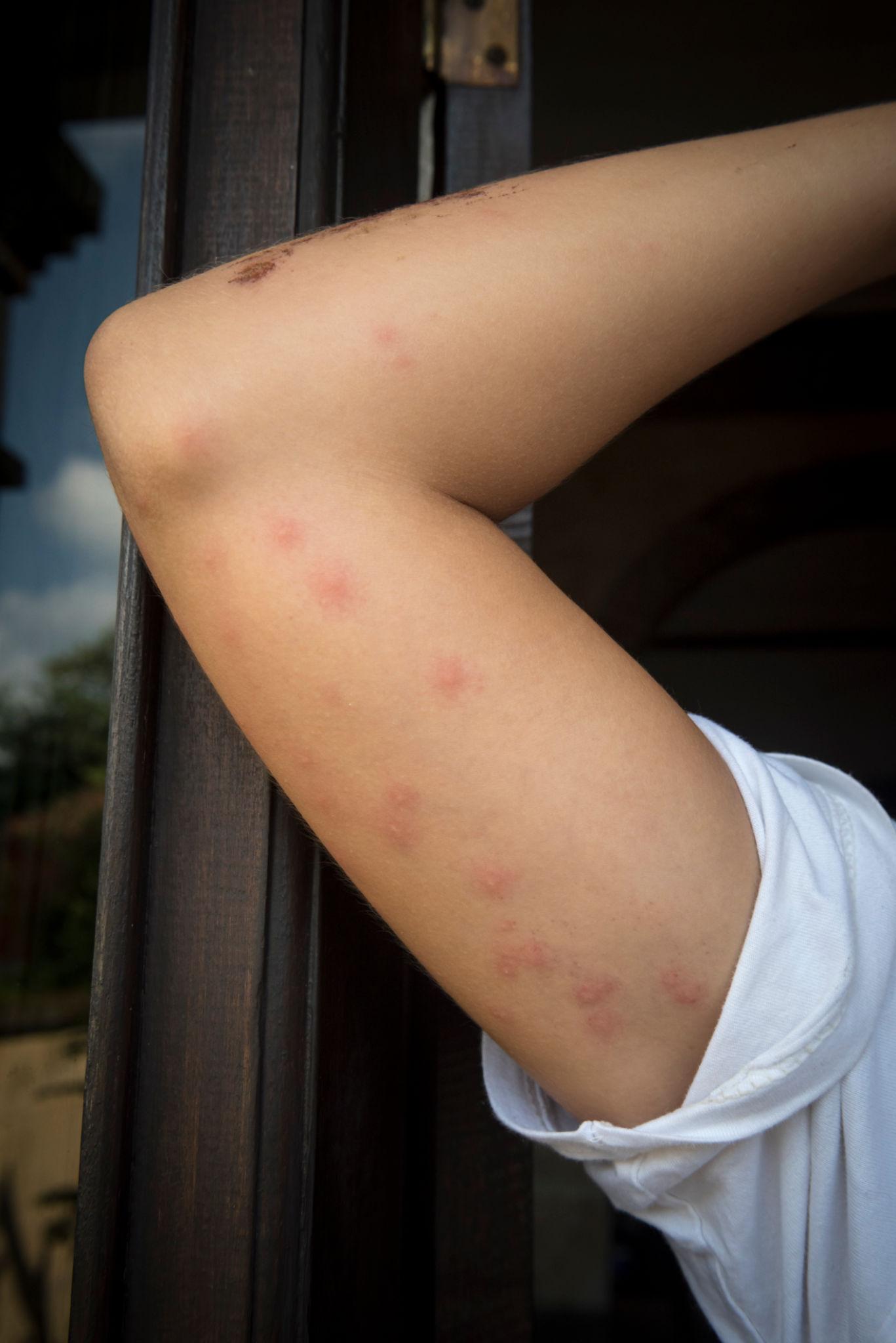 Bed bug bites appearing in a line pattern on a person’s arm after contact with infested couch furniture