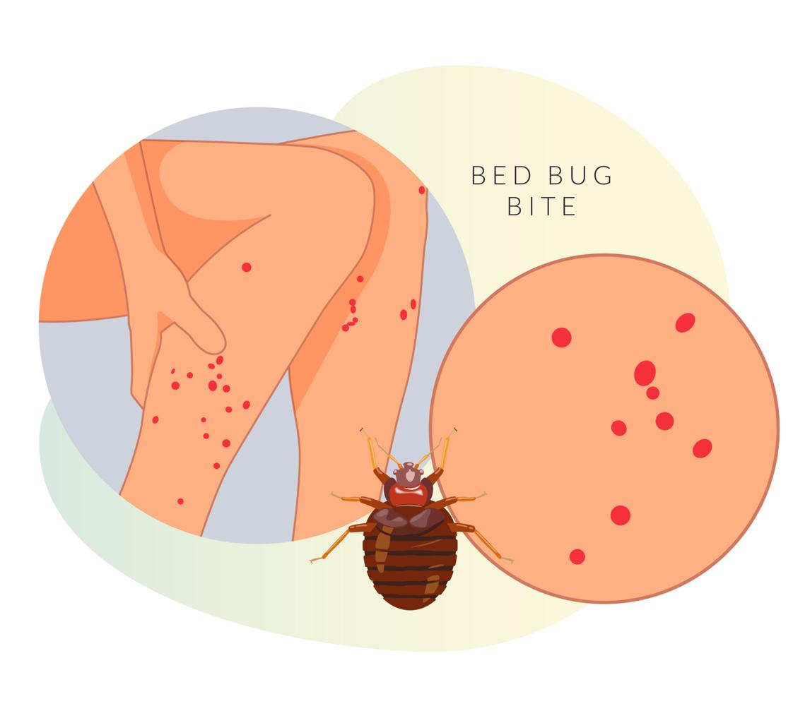 bed bug bites lower leg