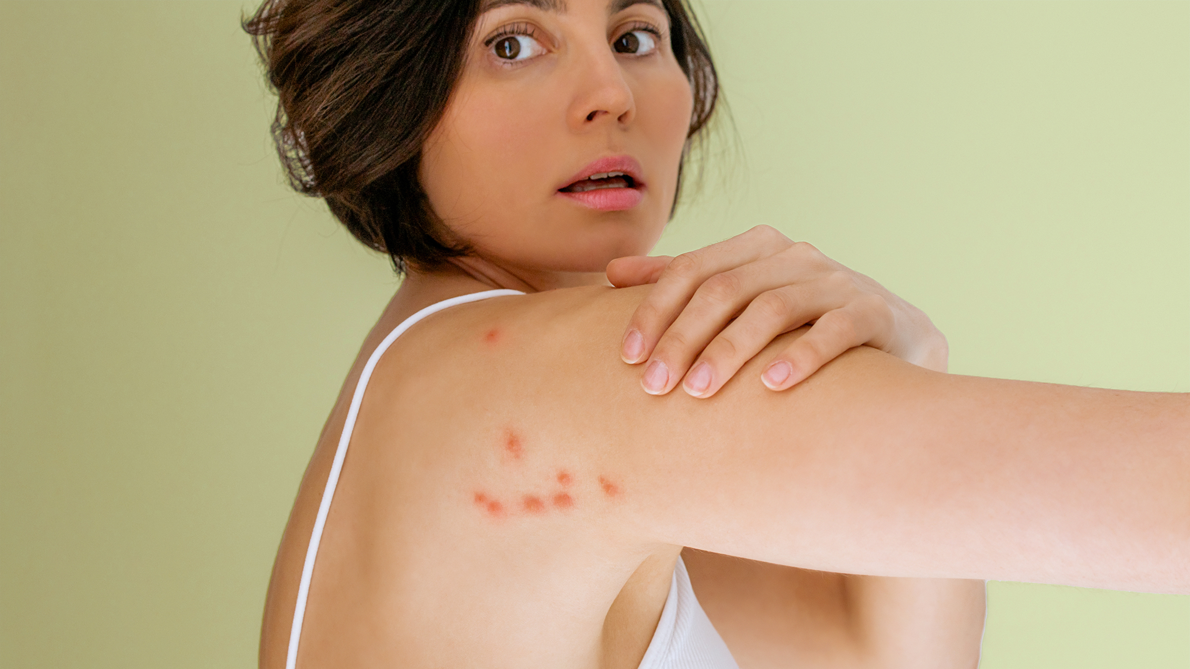 Noticable bed bug bites