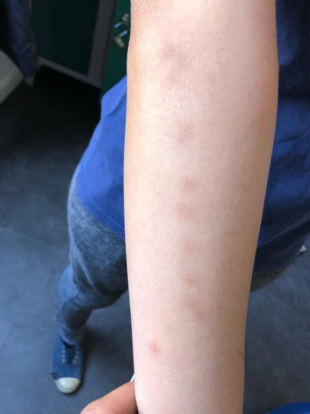 Bed bug bites on the arms