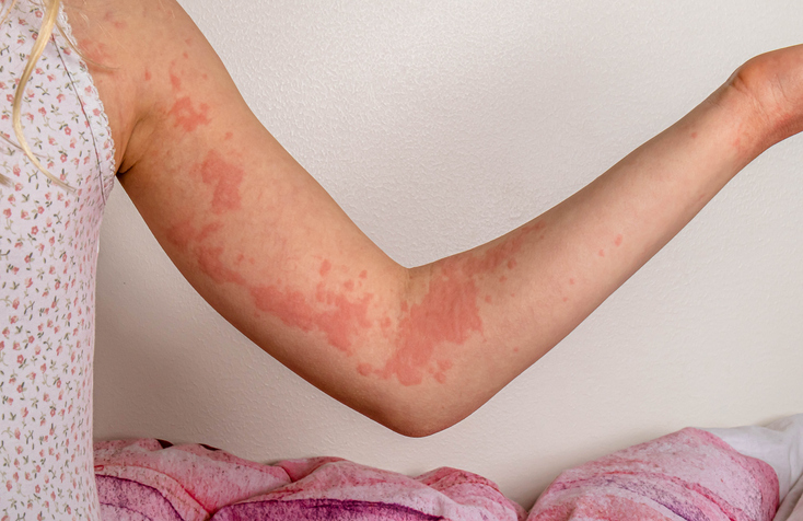 hives that can be mistaken for bed bug bites
