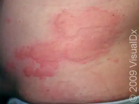 bed bug looking hives