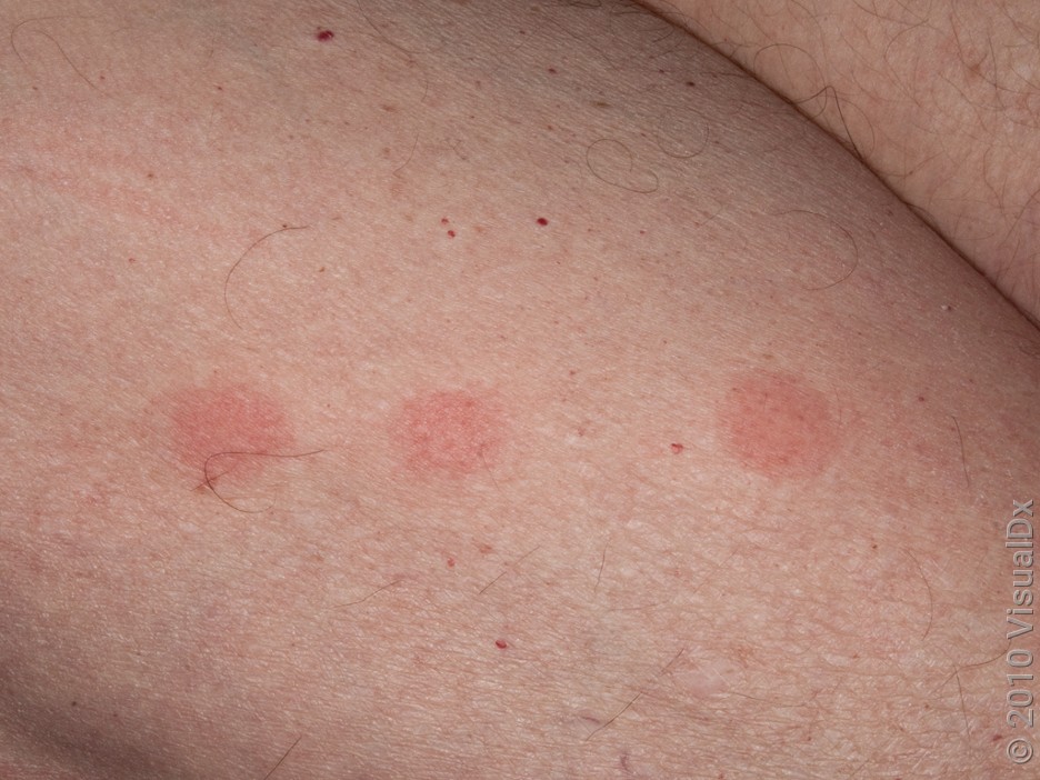 Mosquito bites that look bed bug bites
